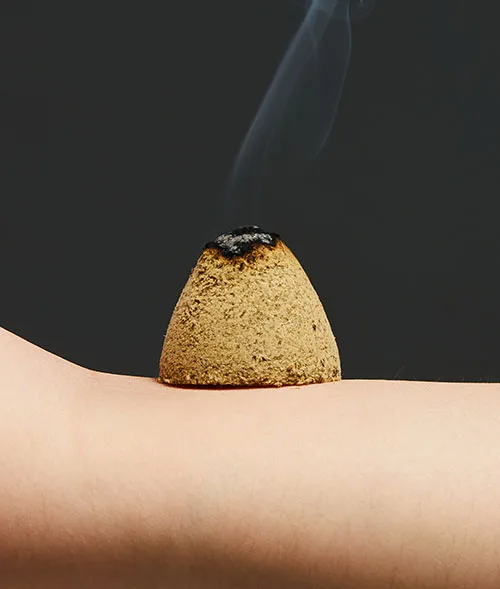 뜸치료 장면